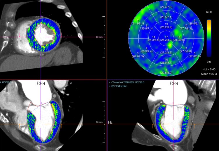Myocardial extracellular volume fraction by computed tomography vs. cardiovascular magnetic resonance imaging in patients with stable chest pain.