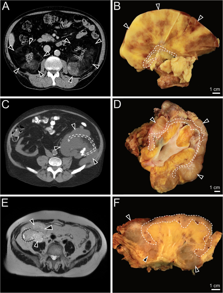 Perinephric myxoid pseudotumor of fat - histopathological and molecular characterization of 3 cases after renal transplantation.