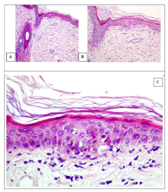 Successful Management of Steroid-Resistant cutaneous Acute Graft-versus-Host Disease, Toxic Epidermal Necrolysis-Like, with Ruxolitinib.