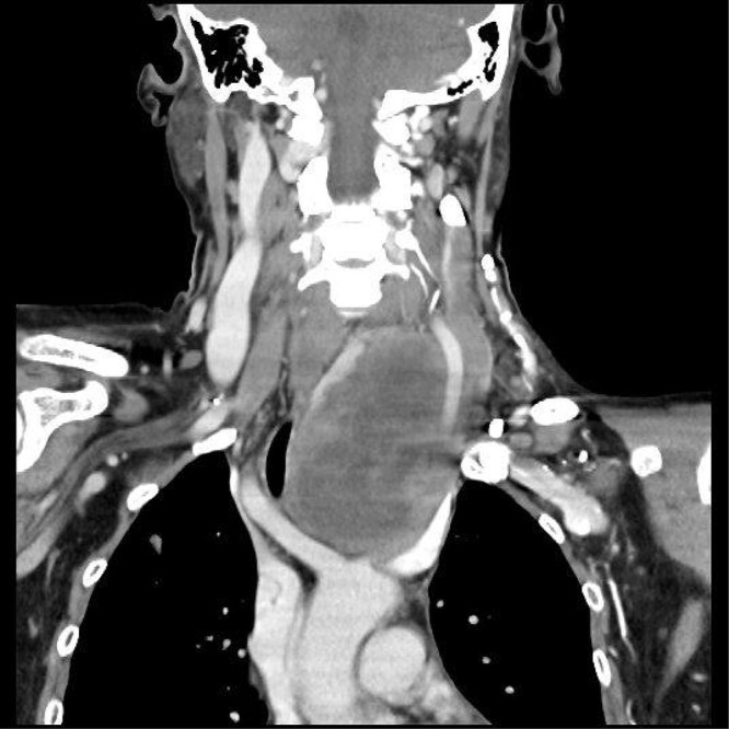 Comprehensive Treatment of Anaplastic Thyroid Cancer: A Case Report.