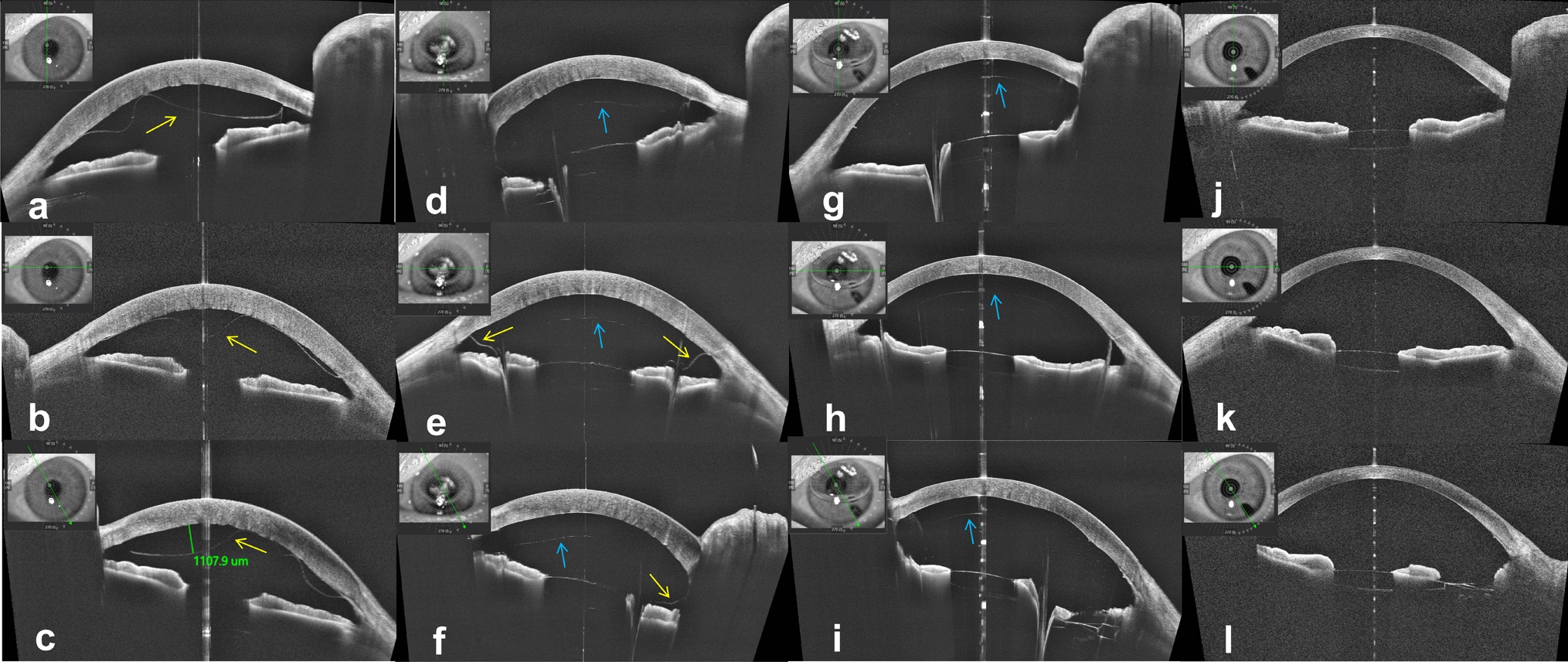 Iridectomy combined with posterior approach anterior chamber gas injection technique: a novel technique for the treatment of extensive Descemet's membrane detachment.