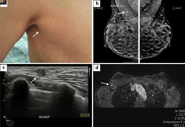 Successful Sentinel Lymph Node Biopsy in Accessory Breast Cancer.