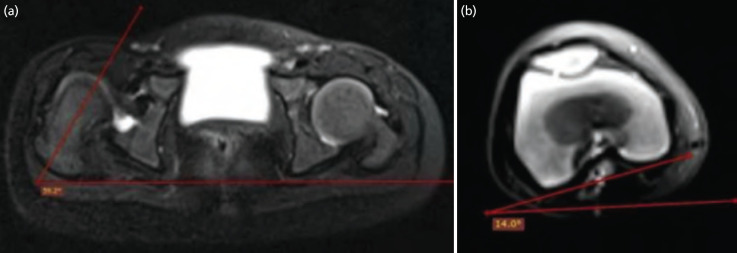 Can Pre-operative MRI Predict the Need for Salter's Osteotomy in DDH Children Undergoing Open Reduction?
