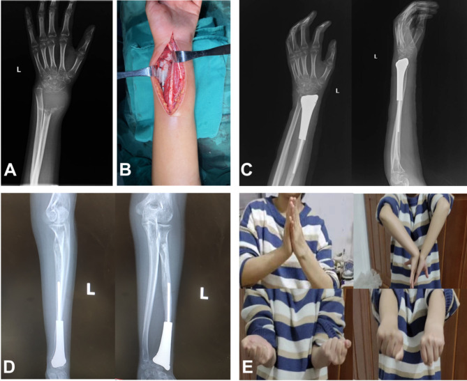 Treatment of distal radius giant cell tumor with 3D-printed metal prosthesis combined with mesh patch.
