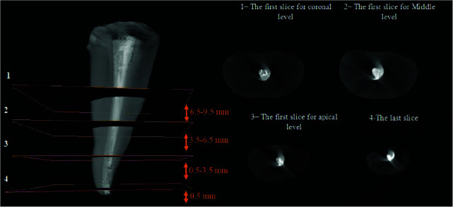 Micro-Computed Tomography Assessment of the Quality of Obturation (Voids) of Single-Canal Maxillary Second Premolars by the Lateral Compaction versus Continuous Warm Vertical Condensation Techniques.