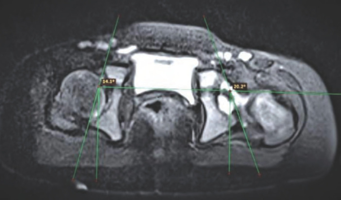 Can Pre-operative MRI Predict the Need for Salter's Osteotomy in DDH Children Undergoing Open Reduction?