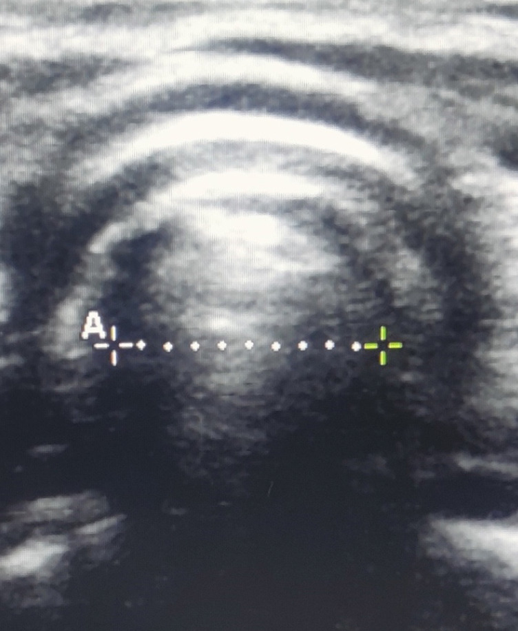 Endotracheal Tube Size Estimation in Paediatric Patients: A Head-to-head Comparison of Accuracy Between Ultrasonography and Age-based Formula.