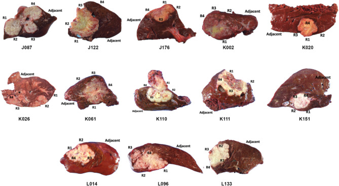 Whole exome sequencing of multi-regions reveals tumor heterogeneity in Opisthorchis viverrini-associated cholangiocarcinoma.