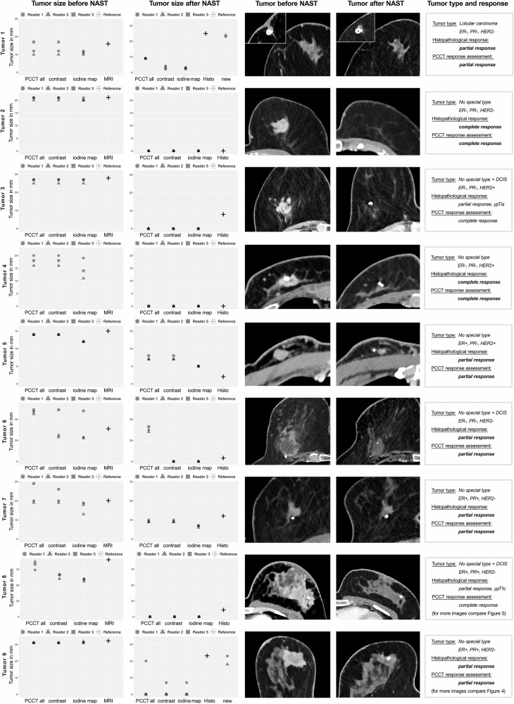 Breast cancer assessment under neoadjuvant systemic therapy using thoracic photon-counting detector computed tomography in prone position: a pilot study.