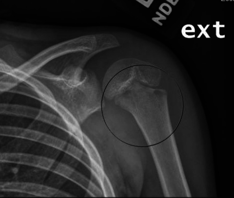 Osteomyelitis and Septic Arthritis of the Upper Extremity in Pediatric Patients.
