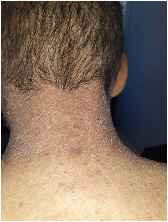 Crusted Scabies in a Malnourished Patient: A Rare Case Report.