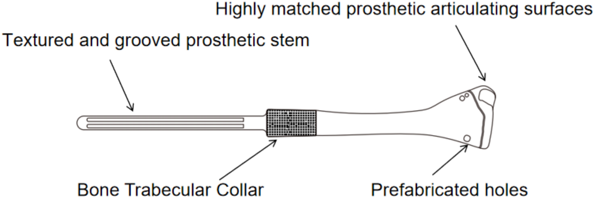 Treatment of distal radius giant cell tumor with 3D-printed metal prosthesis combined with mesh patch.