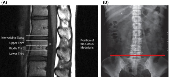 Conus medullaris termination: Assessing safety of spinal anesthesia in the L2-L3 interspace.