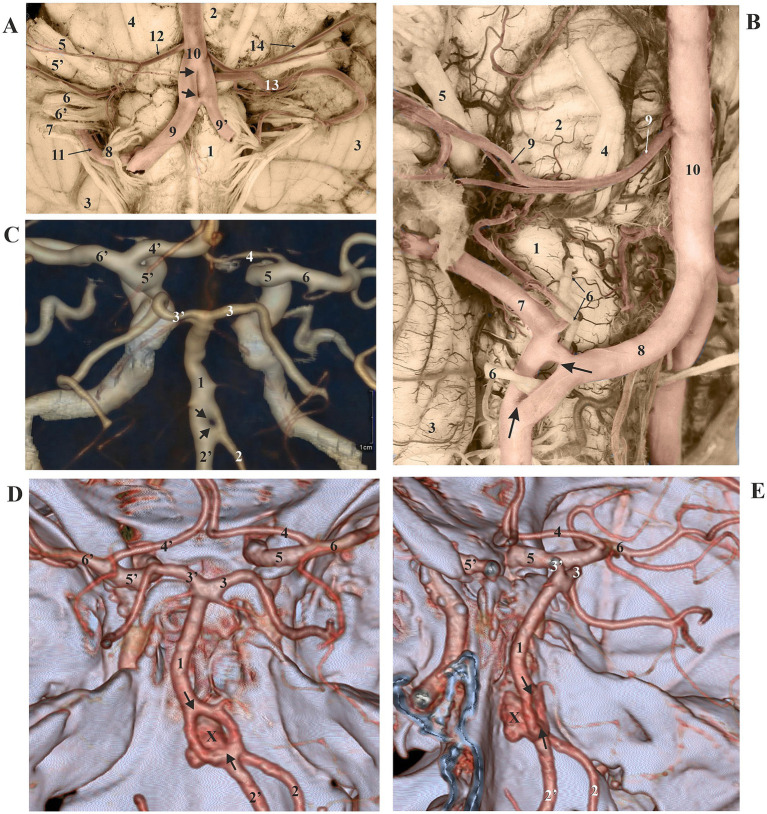 Fenestrations of cerebral arteries and their correlation with brain aneurysms.