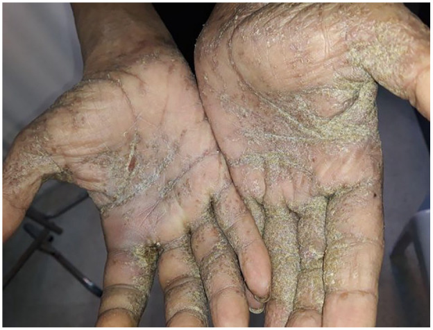 Crusted Scabies in a Malnourished Patient: A Rare Case Report.