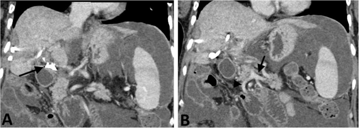 Portal vein reconstruction in iatrogenic portal vein ligation.