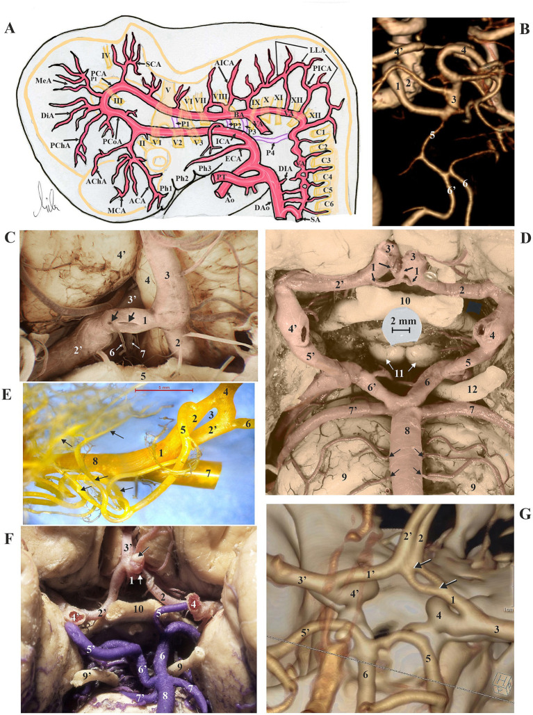 Fenestrations of cerebral arteries and their correlation with brain aneurysms.