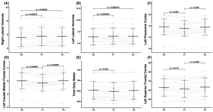 Effects of short-term exposure to moderate amounts of alcohol on brain volume.