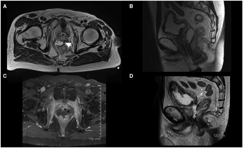 Rectal complications following SpaceOAR insertion after prior pelvic radiation.