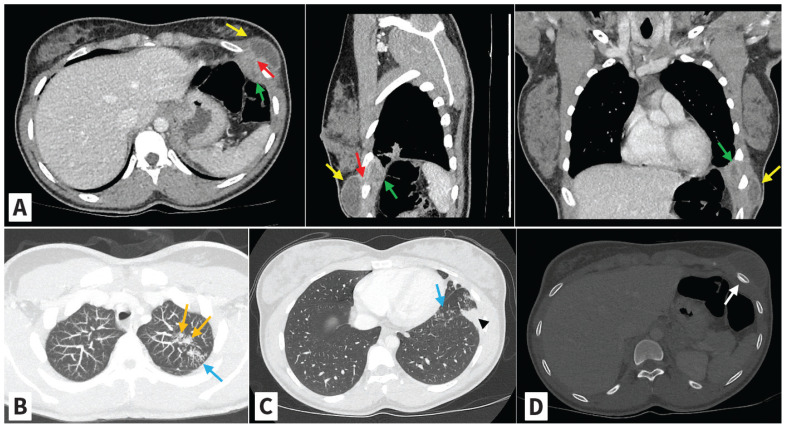 Empyème de nécessité : tableau rare de l’infection à <i>Mycobacterium tuberculosis</i>.