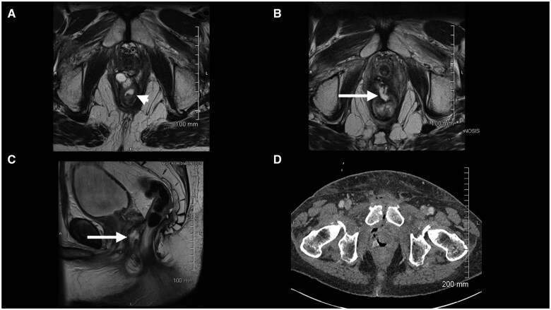 Rectal complications following SpaceOAR insertion after prior pelvic radiation.
