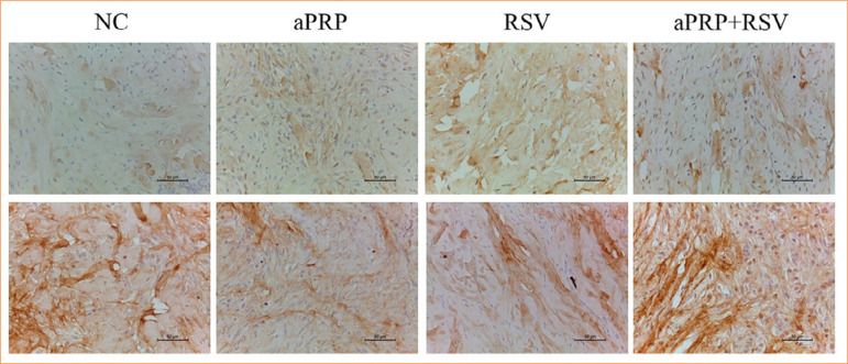 Type I and type III collagen immunoexpression in rabbit skin biopsy samples treated with rosuvastatin gel and autologous platelet-rich plasma.