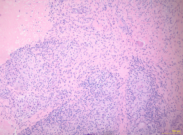 Tuberculosis Osteomyelitis of the Wrist.