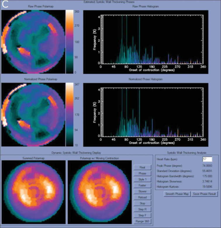 Additive Value of Cardiac Dyssynchrony Parameters using Rest Myocardial Perfusion SPECT in the Diagnosis of Cardiac Sarcoidosis: A Cross-sectional Analytical Study.