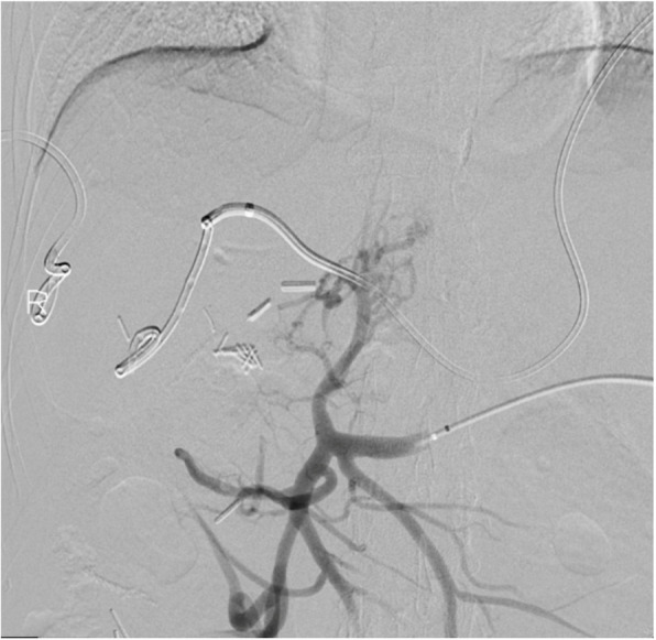 Portal vein reconstruction in iatrogenic portal vein ligation.