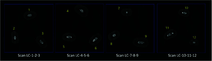 Micro-Computed Tomography Assessment of the Quality of Obturation (Voids) of Single-Canal Maxillary Second Premolars by the Lateral Compaction versus Continuous Warm Vertical Condensation Techniques.