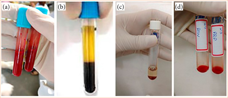 Type I and type III collagen immunoexpression in rabbit skin biopsy samples treated with rosuvastatin gel and autologous platelet-rich plasma.