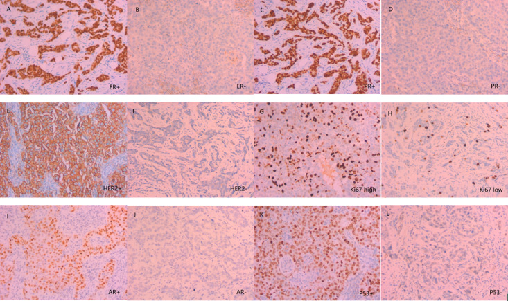 A new marker for predicting sentinel lymph node metastasis in early (cT1-2N0) breast cancer: Tumor-infiltrating lymphocytes (TILs).