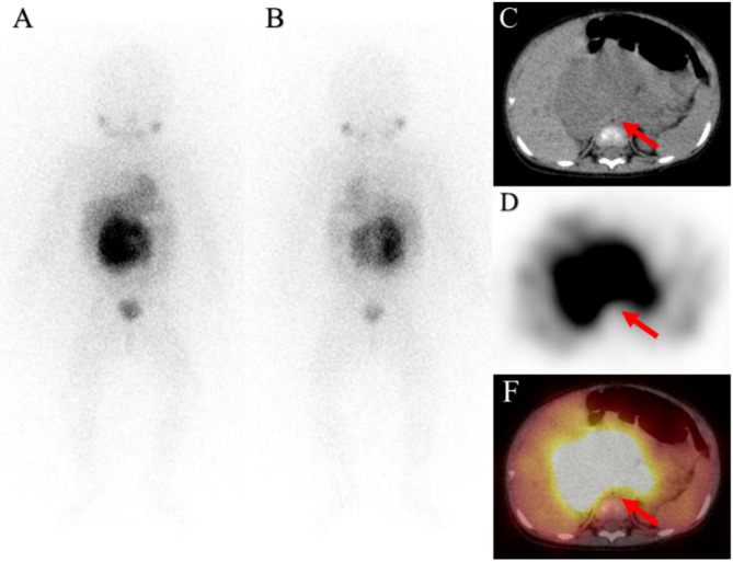 The prognostic significance of semi-quantitative metabolic parameters and tumoral metabolic activity based on <sup>123</sup>I-MIBG SPECT/CT in pretreatment neuroblastoma patients.