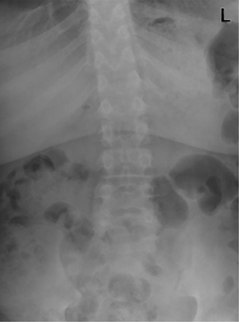 A case report of Prader-Willi syndrome in a child with metabolic disorders and severe obstructive sleep apnea treated effectively with continuous positive airway pressure.