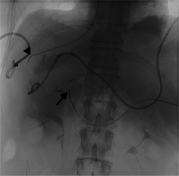 Portal vein reconstruction in iatrogenic portal vein ligation.