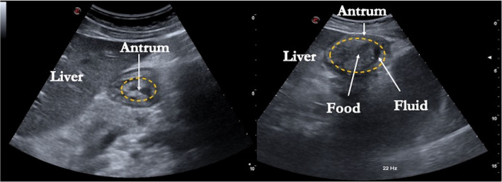 A narrative review of glucagon-like peptide-1 receptor agonists prior to deep sedation or general anesthesia.