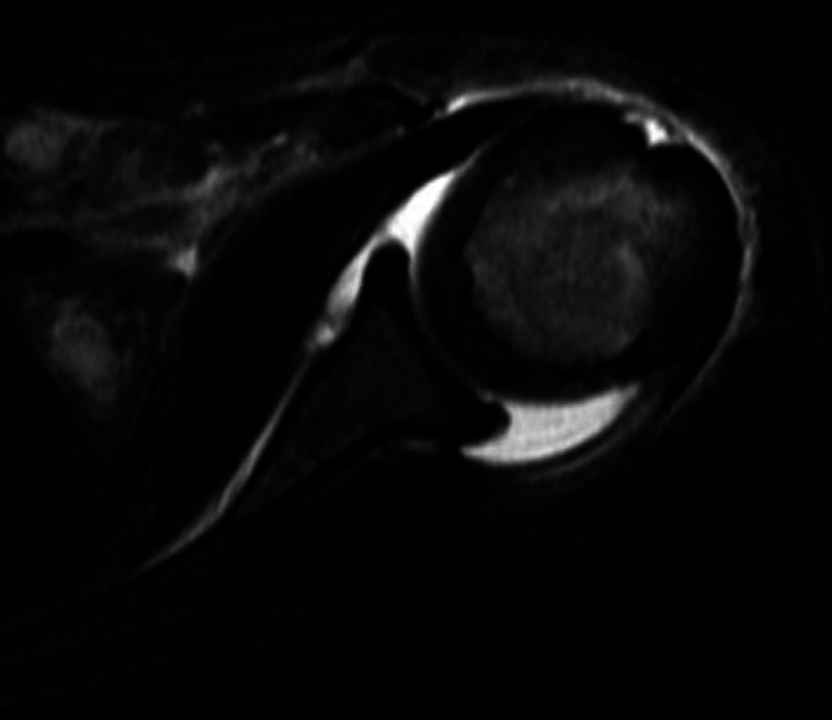 Osteomyelitis and Septic Arthritis of the Upper Extremity in Pediatric Patients.