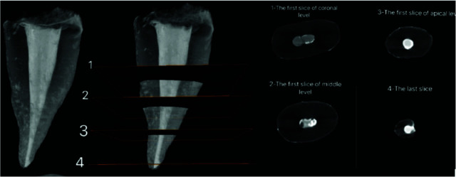 Micro-Computed Tomography Assessment of the Quality of Obturation (Voids) of Single-Canal Maxillary Second Premolars by the Lateral Compaction versus Continuous Warm Vertical Condensation Techniques.