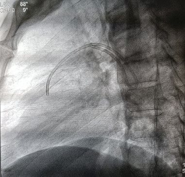 A Rare Case of Dislodged Chemoport Catheter Entrapment in the Pulmonary Artery.