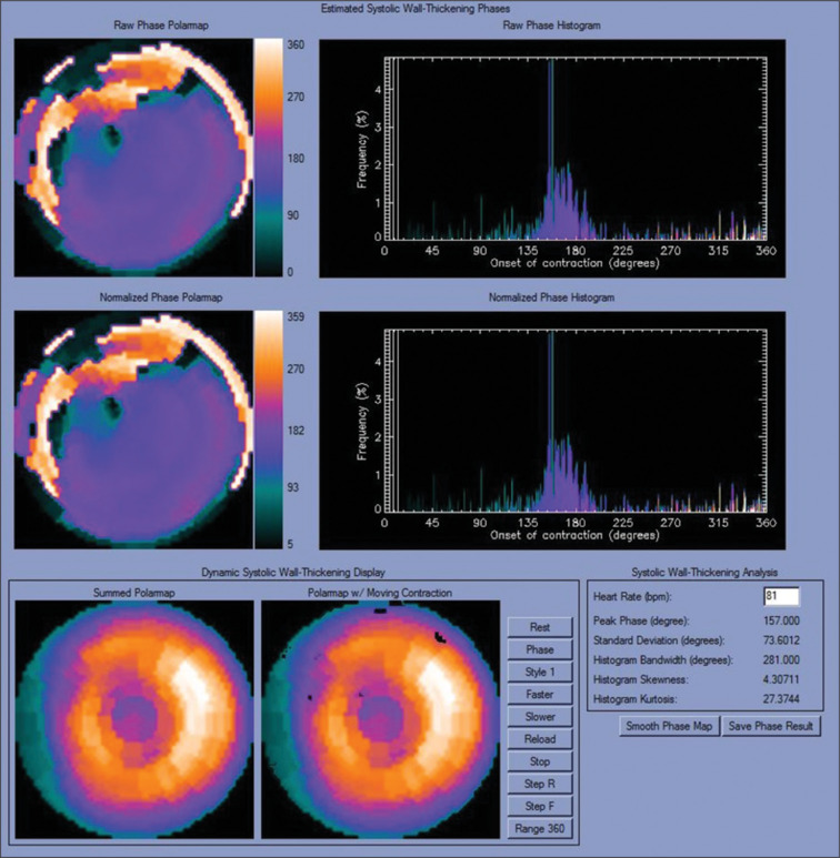 Additive Value of Cardiac Dyssynchrony Parameters using Rest Myocardial Perfusion SPECT in the Diagnosis of Cardiac Sarcoidosis: A Cross-sectional Analytical Study.