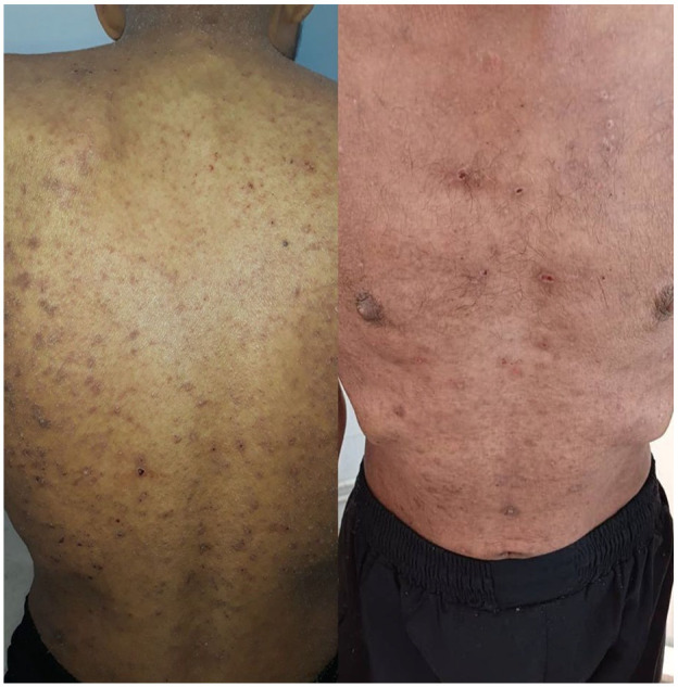 Crusted Scabies in a Malnourished Patient: A Rare Case Report.