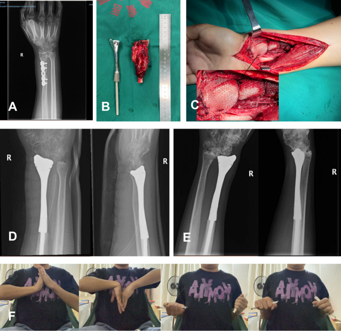 Treatment of distal radius giant cell tumor with 3D-printed metal prosthesis combined with mesh patch.