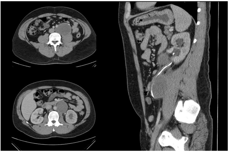 Implementing High-Quality Retroperitoneal Lymph Node Dissection for Testicular Cancer at an Australian Tertiary Hospital: Challenging the Centralisation Paradigm in High-Need Areas.