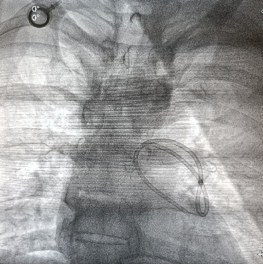 A Rare Case of Dislodged Chemoport Catheter Entrapment in the Pulmonary Artery.