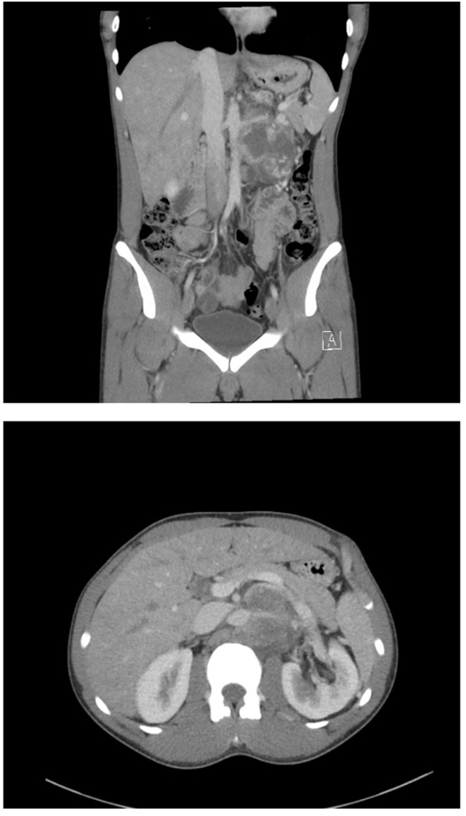 Implementing High-Quality Retroperitoneal Lymph Node Dissection for Testicular Cancer at an Australian Tertiary Hospital: Challenging the Centralisation Paradigm in High-Need Areas.