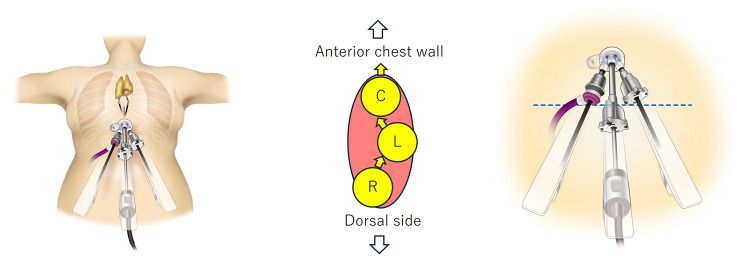 Subxiphoid uniportal robotic thymectomy using da Vinci Xi system†.