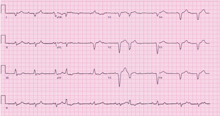 Immune Checkpoint Inhibitor-induced Myocarditis: A Case Report of Complete Heart Block and Challenges in a Patient on Pembrolizumab.