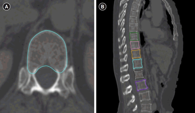 Hounsfield units predict vertebral compression fractures in gastric cancer survivors after adjuvant irradiation.