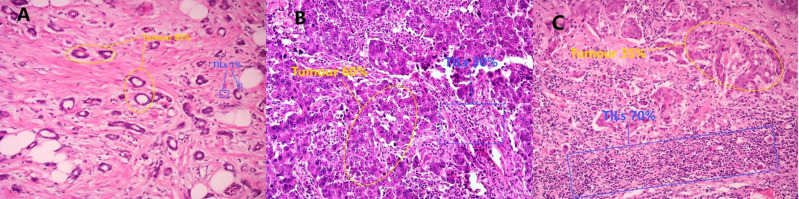A new marker for predicting sentinel lymph node metastasis in early (cT1-2N0) breast cancer: Tumor-infiltrating lymphocytes (TILs).