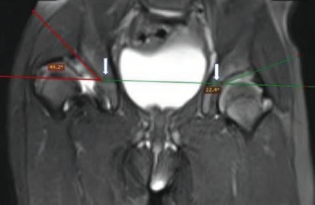 Can Pre-operative MRI Predict the Need for Salter's Osteotomy in DDH Children Undergoing Open Reduction?